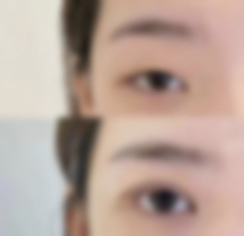 术后怎样护理能让祛黑眼袋成效更好