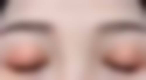 纳米无痕双眼皮加开眼角多久能修复?