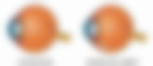 佩戴双眼皮定型器睡成双眼皮值不值