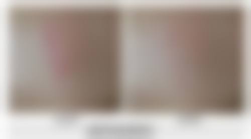 割双眼皮十天修复情况和手术方式有关吗