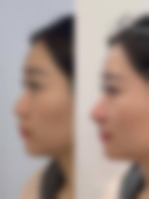 温州维纳斯医疗美容医院真实实例：见证美丽蜕变