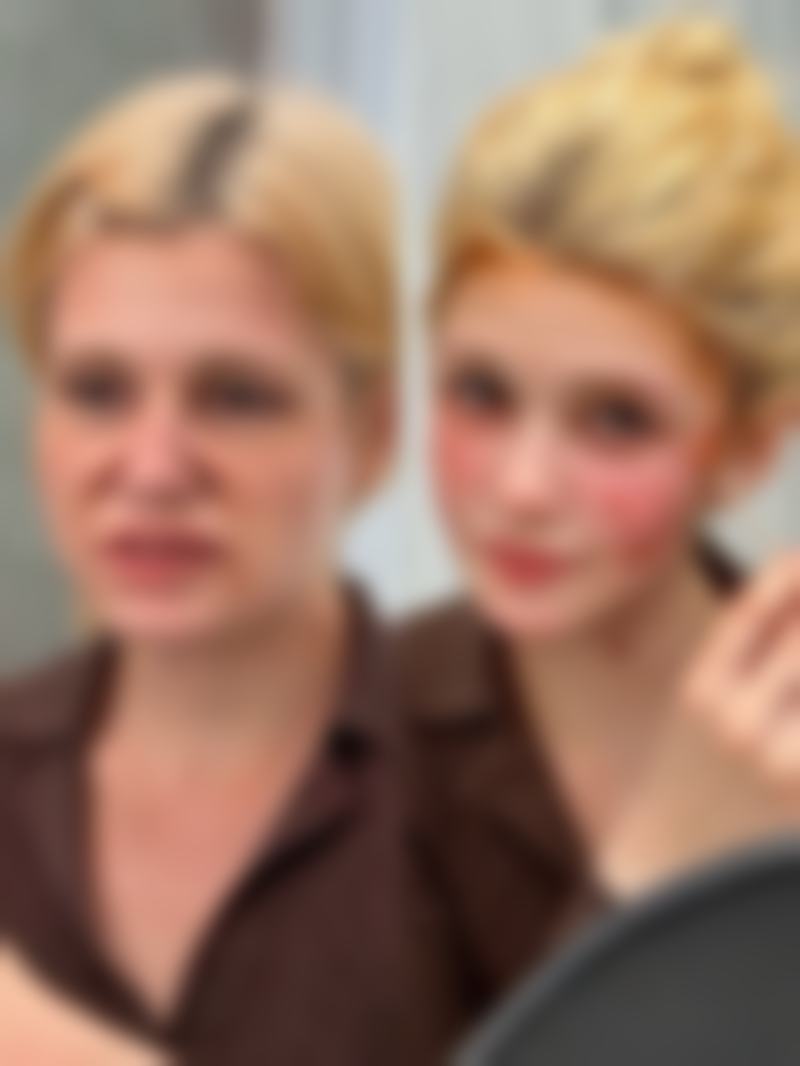 纳米无痕双眼皮与开眼角联合手术的值不值?