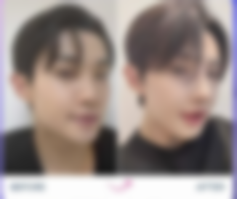 割双眼皮十天能修复到什么程度