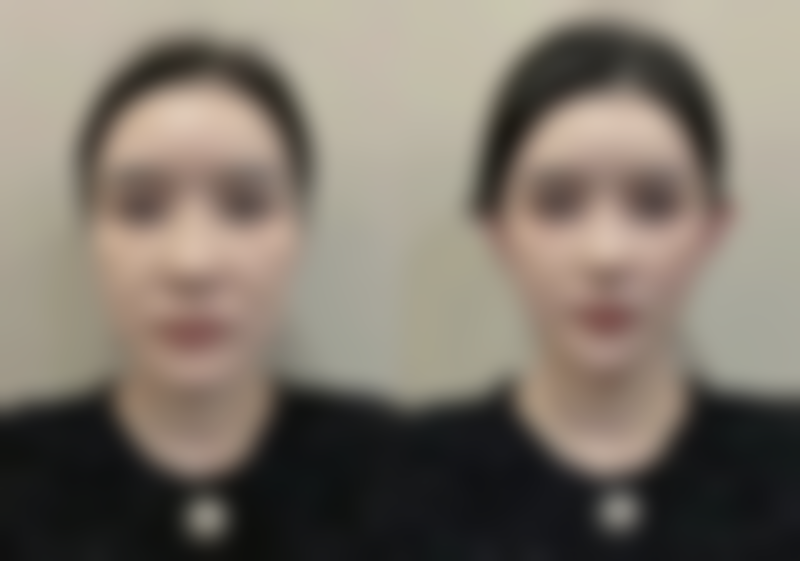 做全切双眼皮有风险吗？揭秘：正规操作下风险可控，助你安心拥有迷人双眸！ 