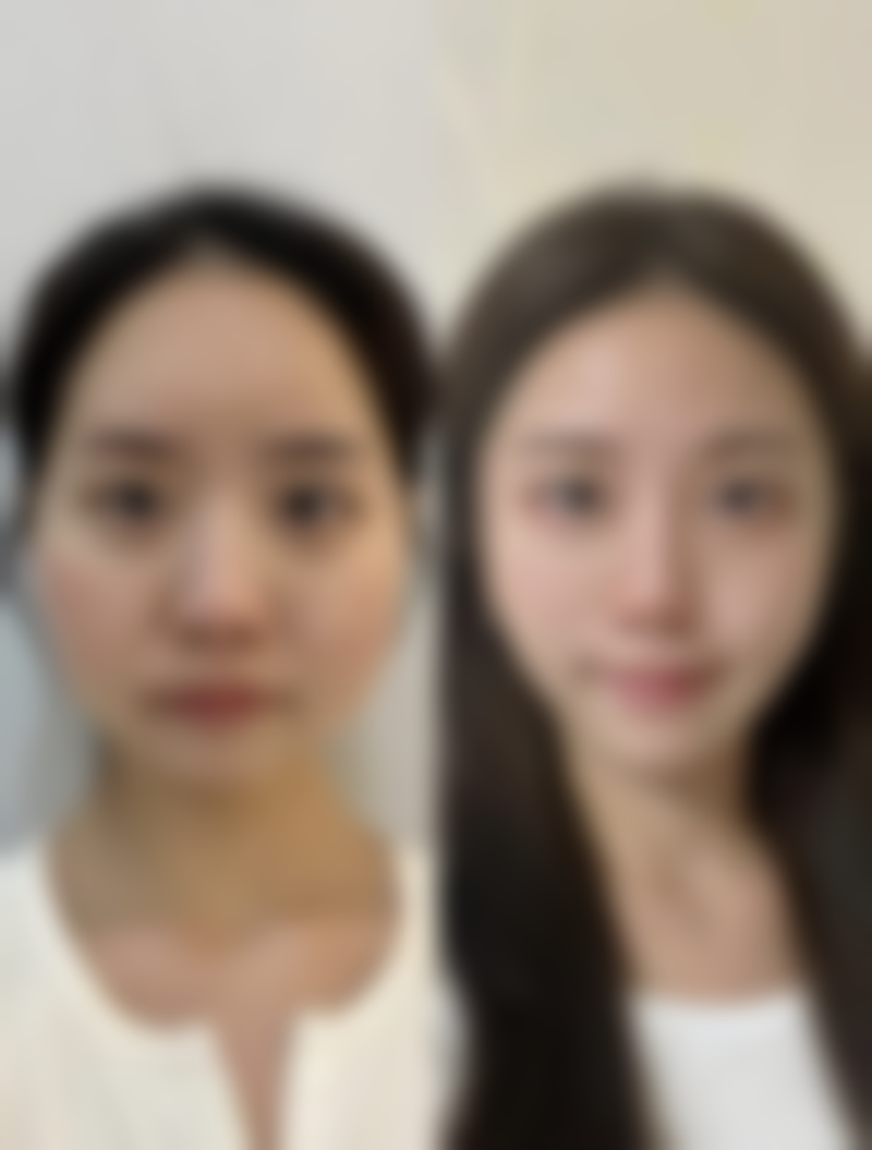 如何做能降低全切双眼皮手术风险