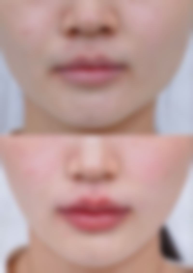 割双眼皮十天修复受个人体质影响大吗