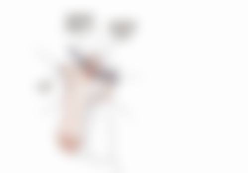 为何一只单眼皮一只双眼皮？原来是这些原因，医美手段可改善，让你双眼对称更迷人！ 