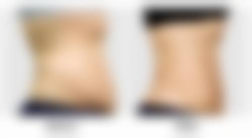 打瘦脸针后吃柚子有什么注意事项