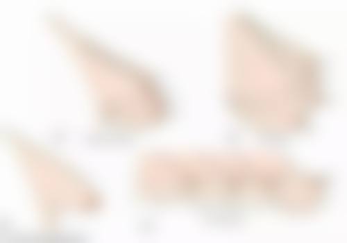 做什么双眼皮最好最安全？切开双眼皮成型自然持久，埋线双眼皮恢复快创伤小，各有优势任你选！ 