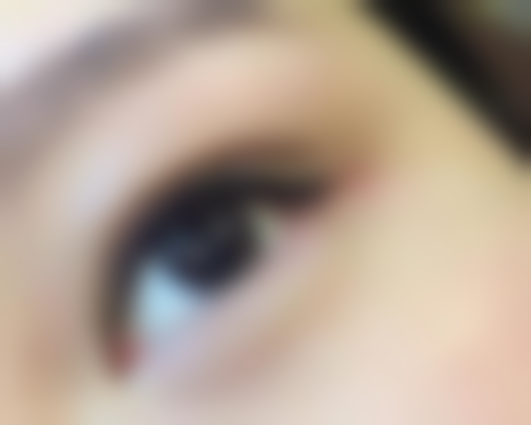 埋线双眼皮适合所有人吗