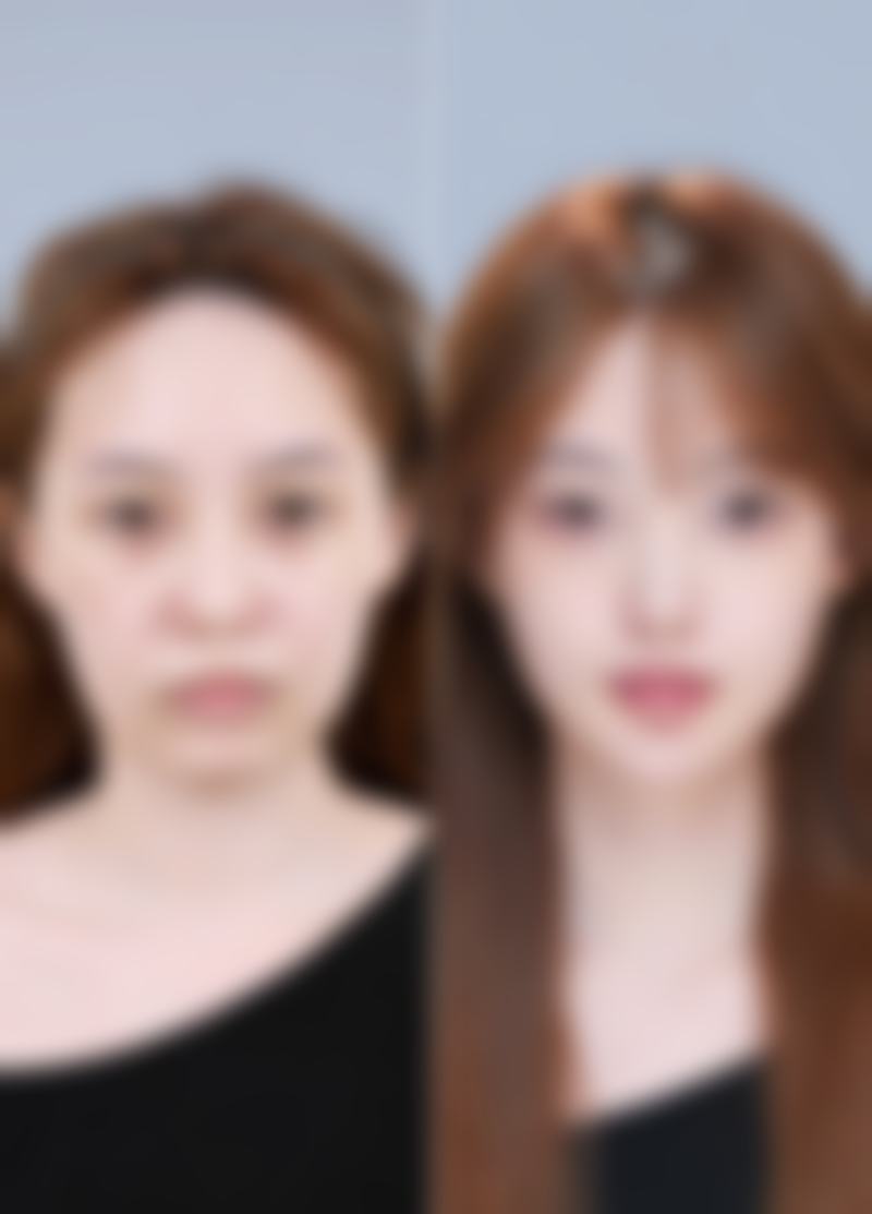 如何判断内双父母生出双眼皮宝宝的可能性