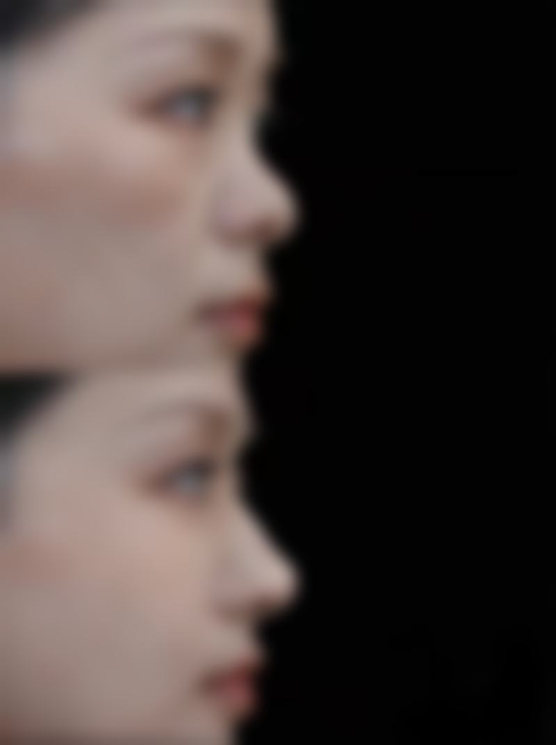 注射填充除皮肤凹陷疤痕值不值