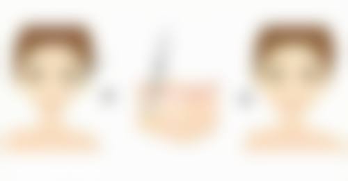 瘢痕体质做无痕双眼皮靠谱吗