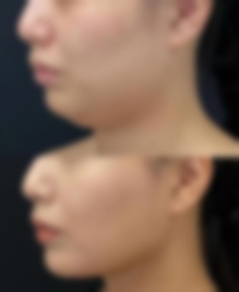 隆胸假体质量检测值不值