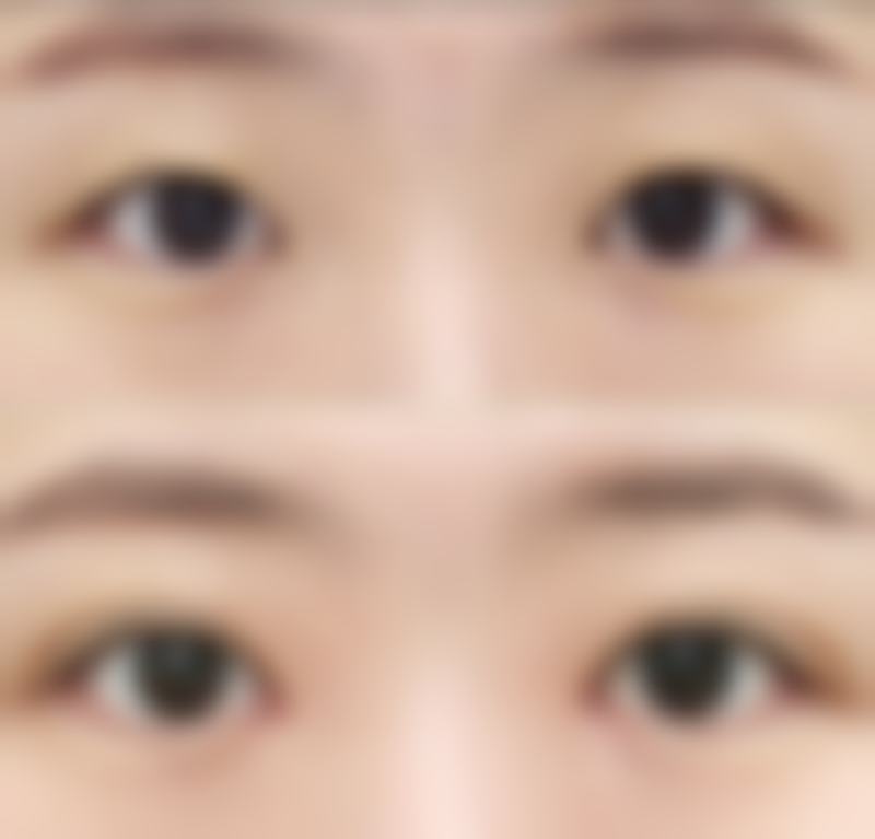 瘢痕体质可以做无痕双眼皮吗？专业解答：虽有风险但并非绝对不行，选对方法也能拥有迷人双眼皮！ 