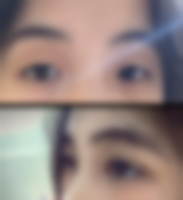 三阶段治疗法去除眼袋值不值