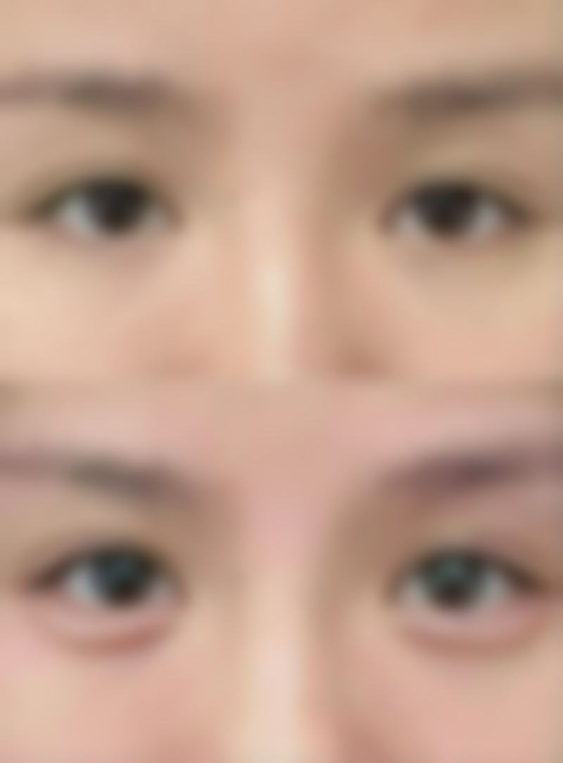 小腿肚抽脂成效怎么样