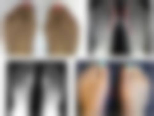 360环吸和水动力吸脂哪个更适合面部吸脂？