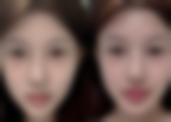 割双眼皮用祛疤膏能完全去除疤痕吗