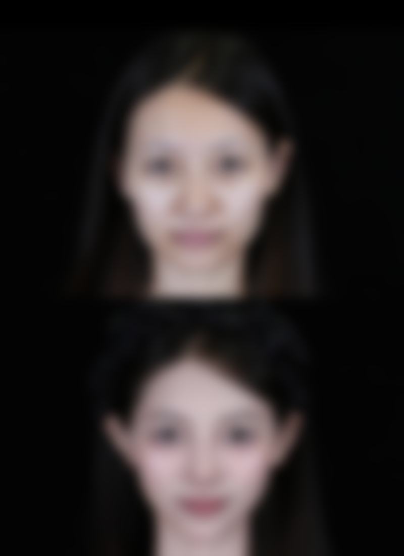 打瘦脸针怎样避免苹果肌下垂