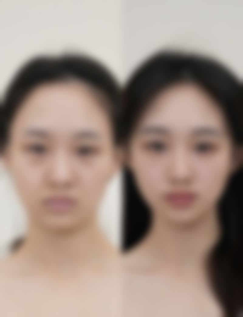 打完瘦脸针修复期间要注意什么?