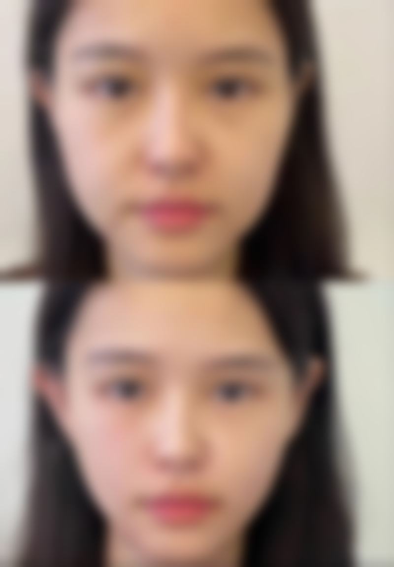 个体代谢差异对打完瘦脸针修复时间有什么影响?