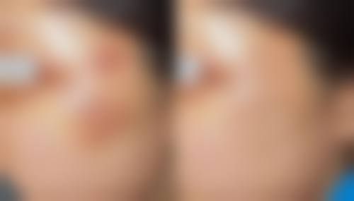 去眼袋手术后如何快速修复