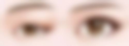 去眼袋手术多久恢复？一般1-3个月基本恢复，3-6个月完全恢复自然，为你揭秘快速恢复小窍门！ 