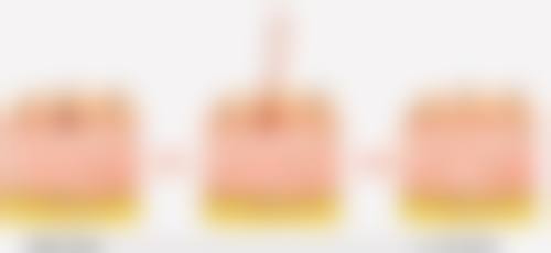 新月形双眼皮对眼皮厚的人成效怎么样