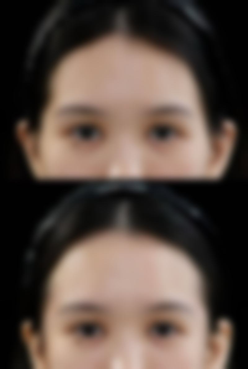 眼皮厚做欧式平行双眼皮值不值