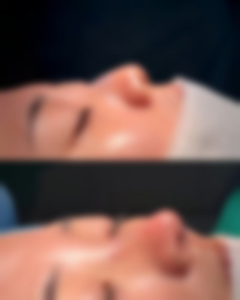 眼皮厚做新月形双眼皮靠谱吗