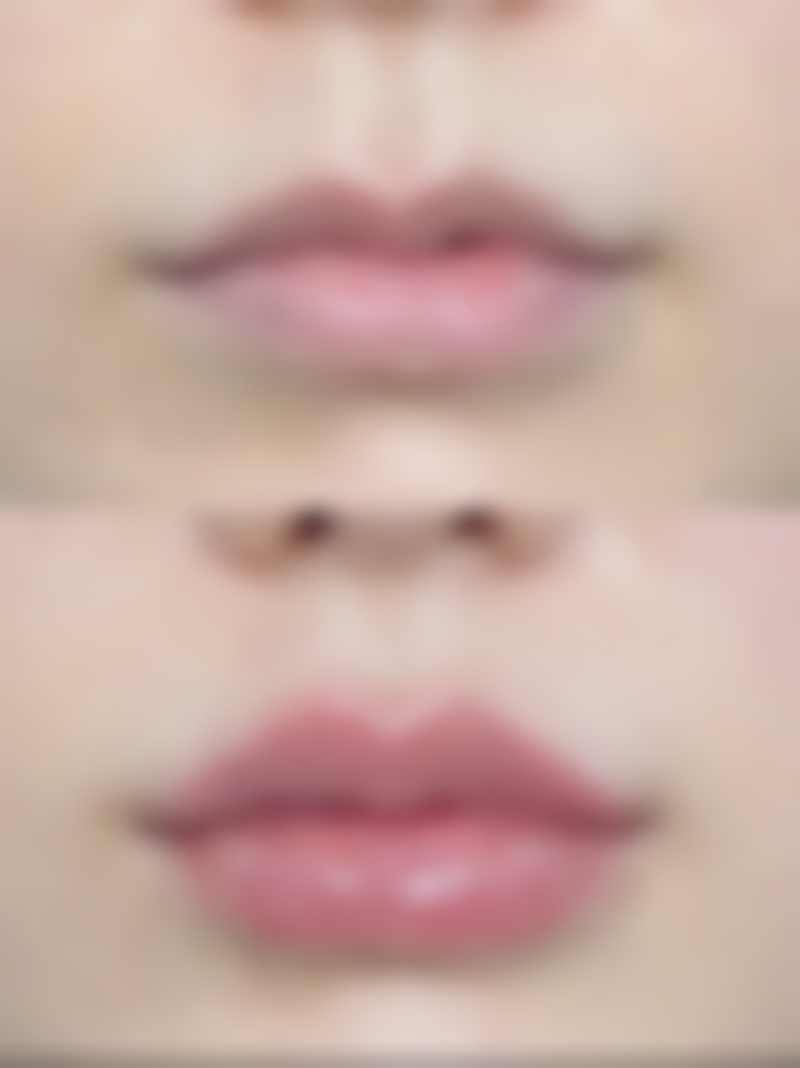 欧式平行双眼皮适合眼皮厚的人吗