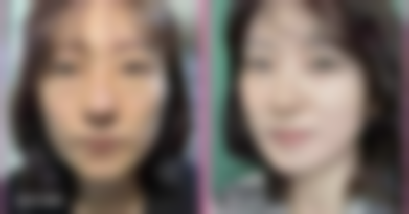 积雪苷霜软膏适合消除疤痕增生吗