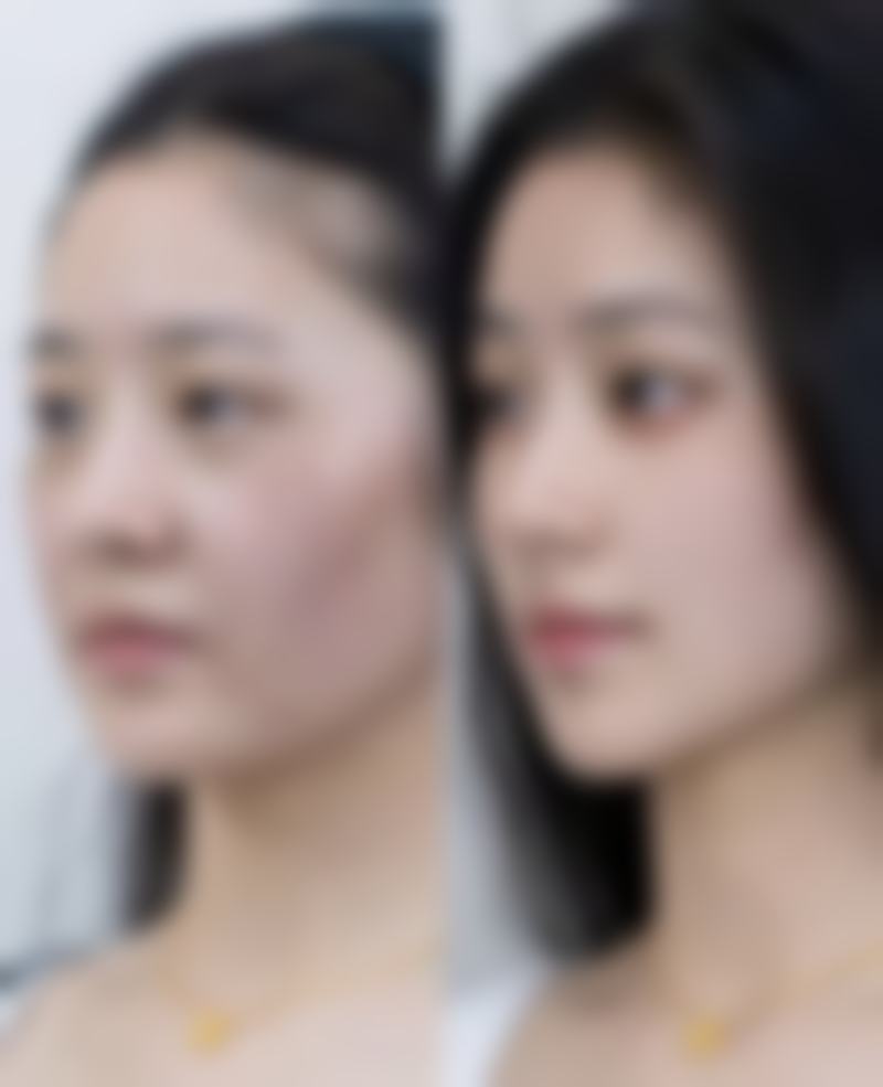 如何判断眼皮厚适合欧式平行还是新月形双眼皮