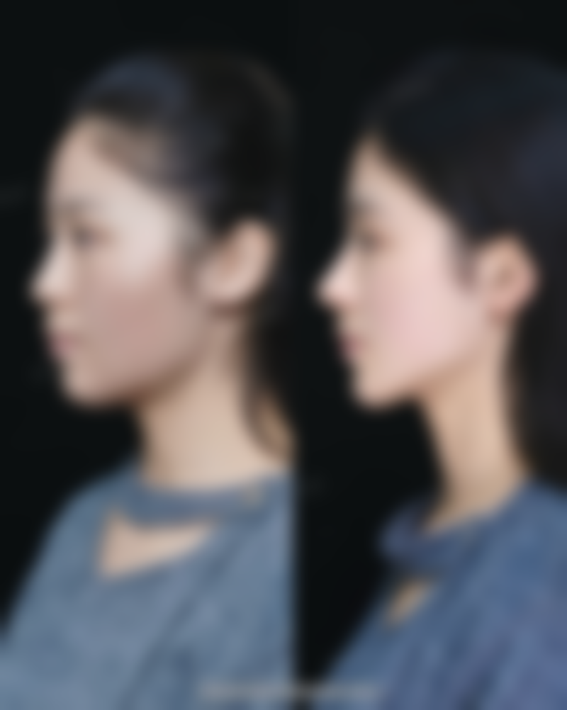 首延整形外科真实实例：见证美丽蜕变