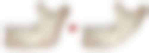 激光祛疤术淡化脸部疤痕适合吗？