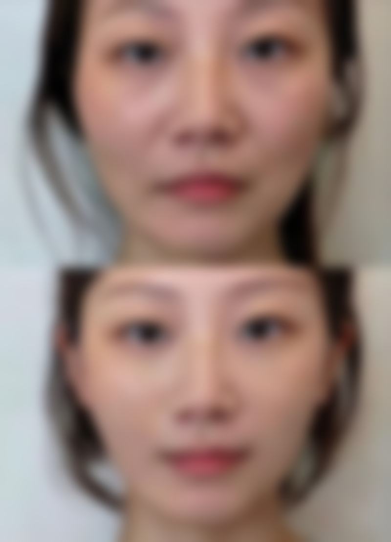 手术治疗脸部疤痕值不值？