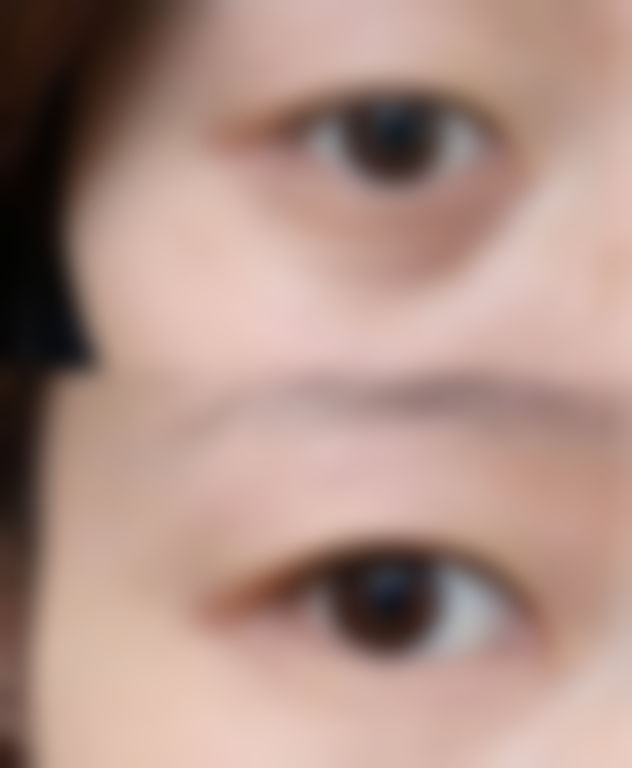 承德亨川整形医院真实实例