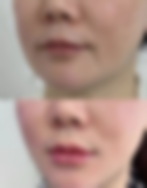 疤痕疙瘩激光治疗有什么优势