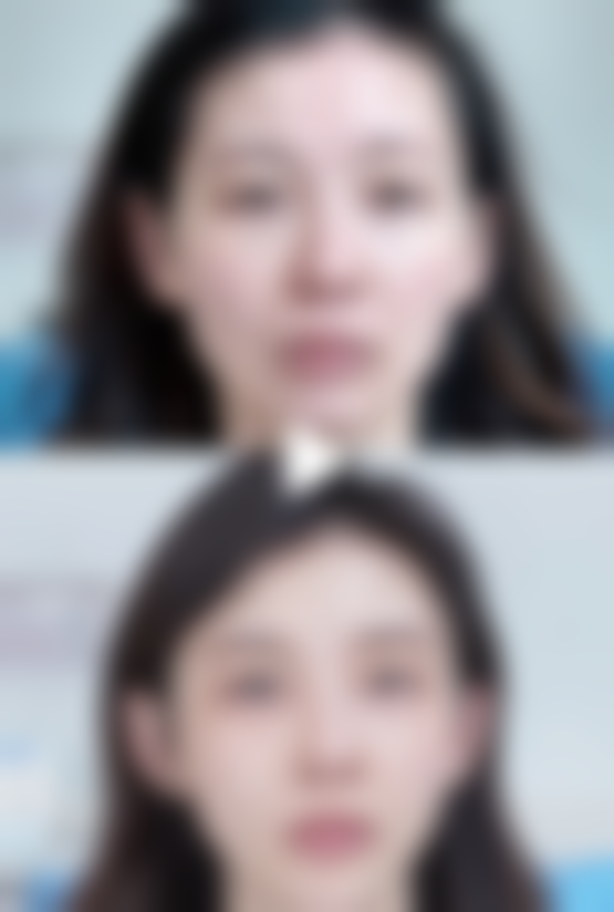 背部吸脂后血清肿出现的概率大吗