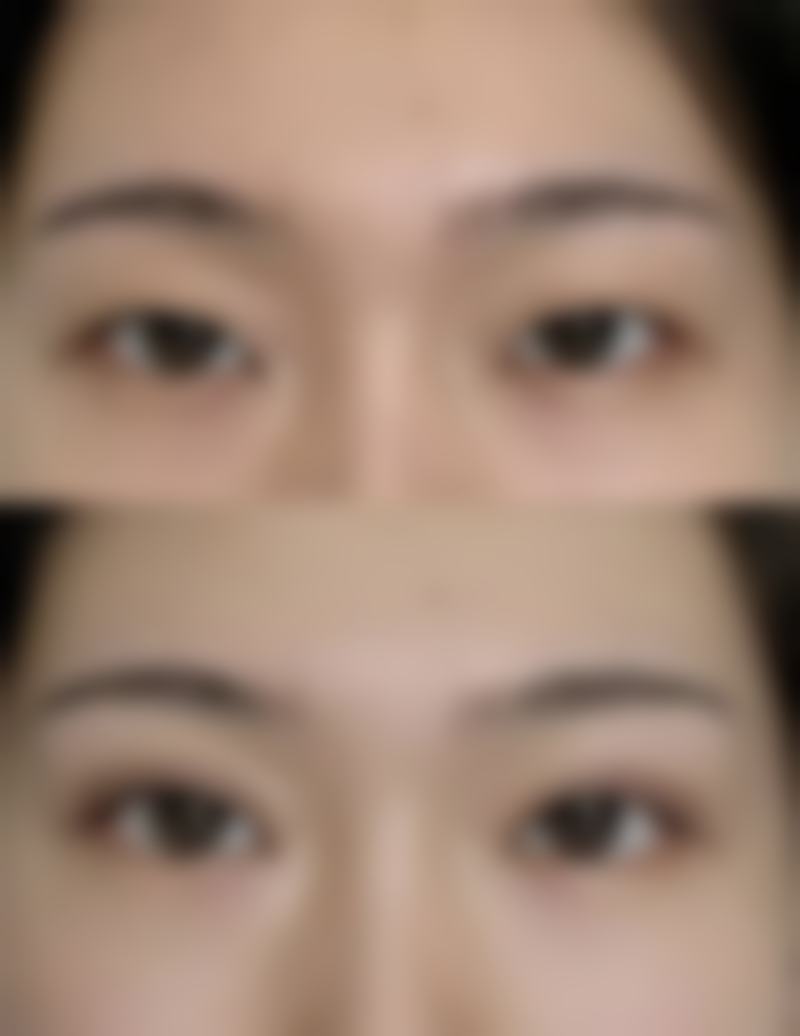 隆鼻可吸收线吸收后成效能维持多久