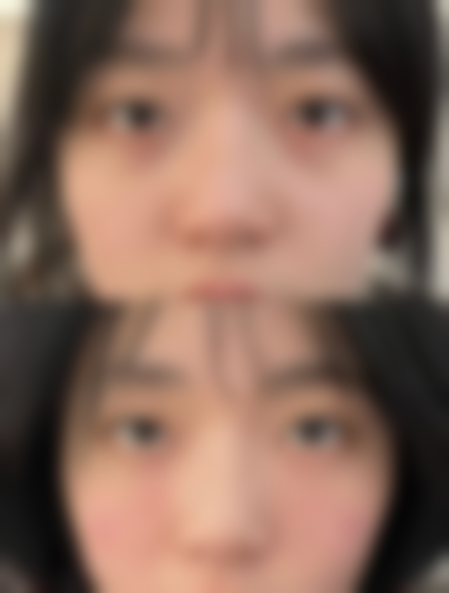 疤痕疙瘩激光治疗成效怎么样