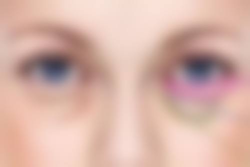 做完眼袋出现疤痕增生可以下去吗？权威揭秘：有效方法让疤痕增生逐渐消失，重获光滑美肌！ 