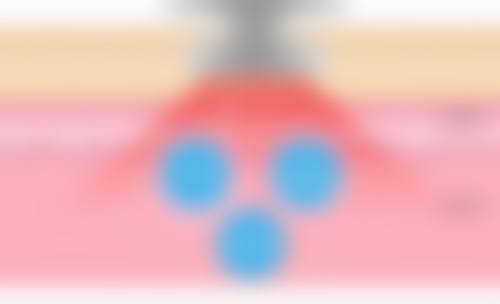 抽脂去眼袋成效持久是真的吗