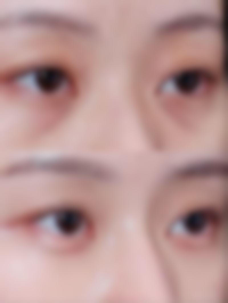 抽脂去眼袋修复时间受哪些因素影响