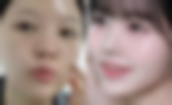 割双眼皮后修复饮食前需要注意什么