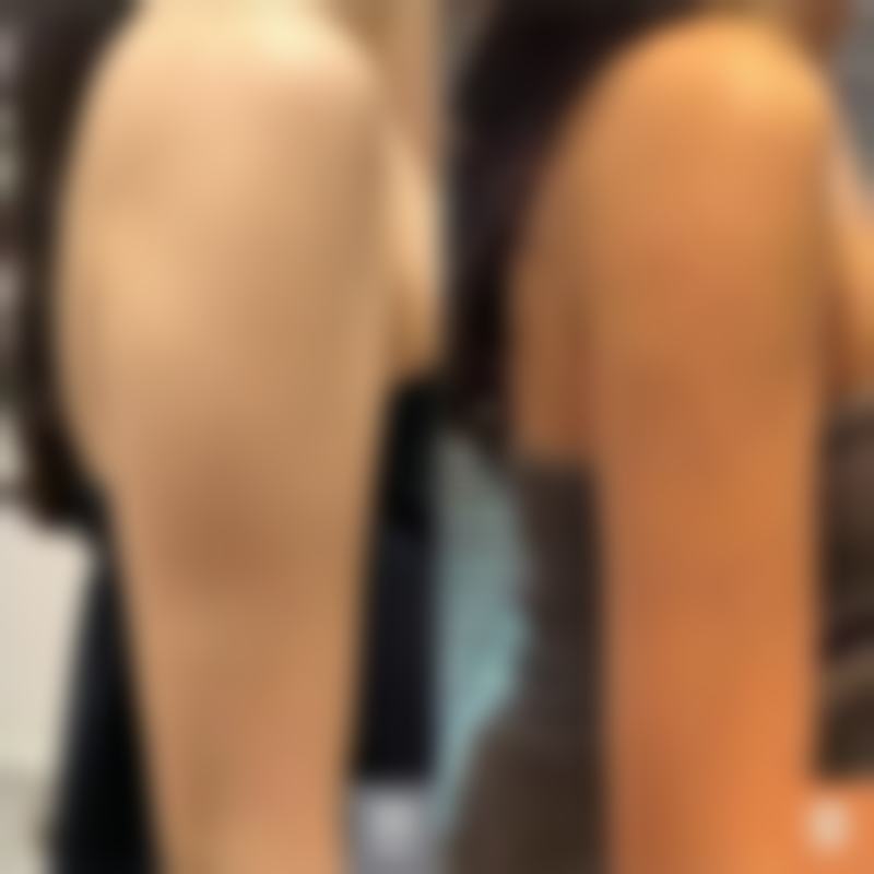 手术疤痕淡化时间靠谱吗