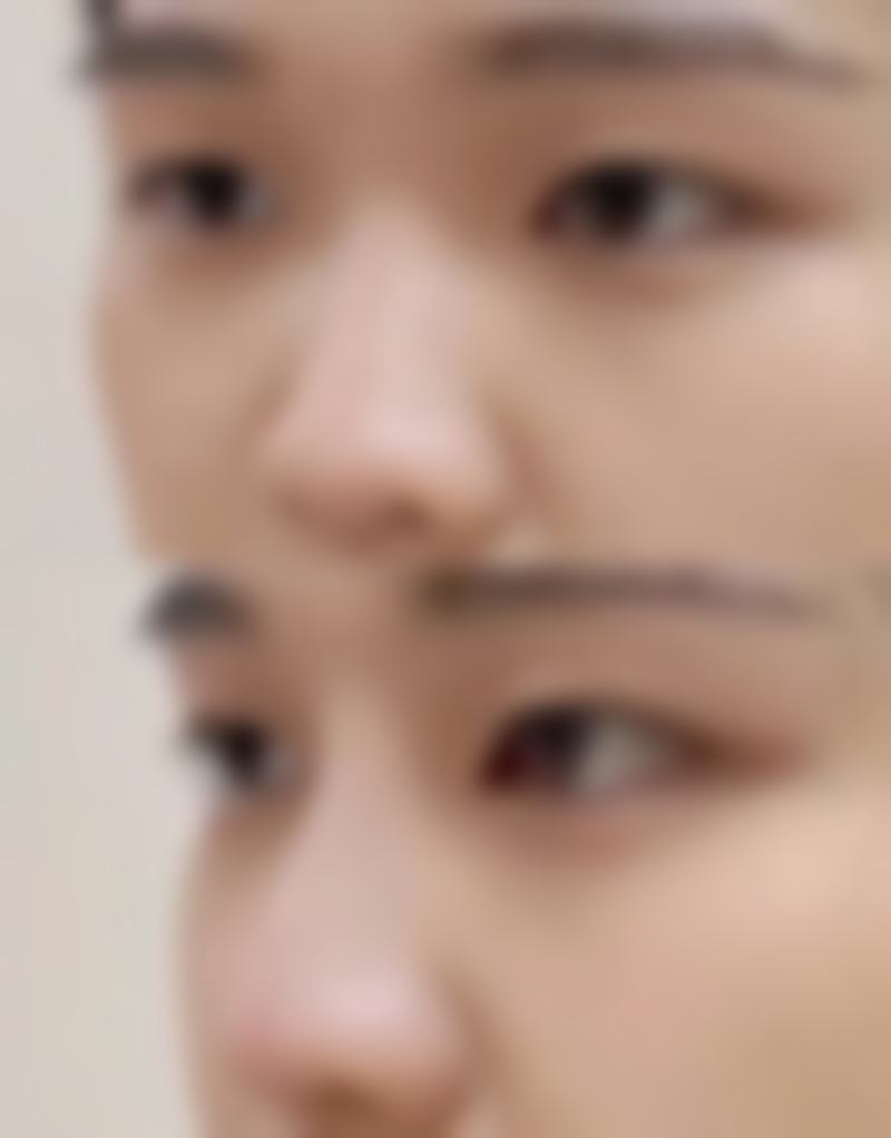 做完眼袋出现疤痕增生和个人体质有关吗