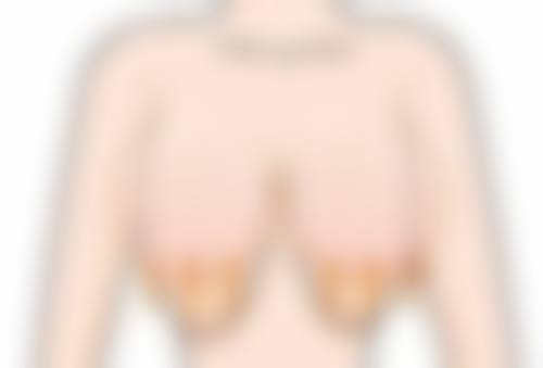 切开法让单眼皮变双眼皮适合我吗