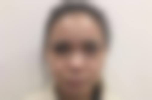 隆鼻后鼻孔内软骨突出修复值不值